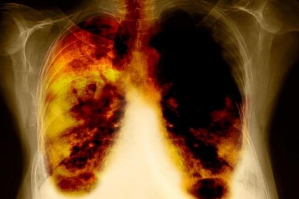 POJAVIO SE SNIMAK O OBDUKCIJAMA ŽRTAVA KORONE U SRBIJI: Pogledajte pažljivo, MEDICINSKI FAKULTET objasnio!