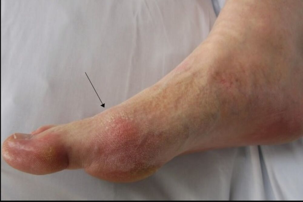 Jedan od rizika holesterola je da može da se nakupi u arterijama što dovodi do začepljenja, sprečavajući krv da prođe