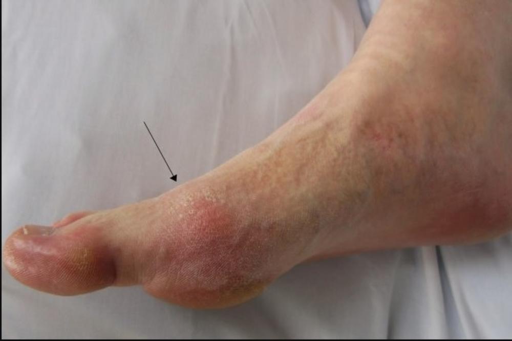 PARAZIT SE GNEZDIO U DEVOJČICINOJ KOŽI! Američki lekari konstatovali TEŠKU infekciju, njen slučaj je opasan (FOTO)