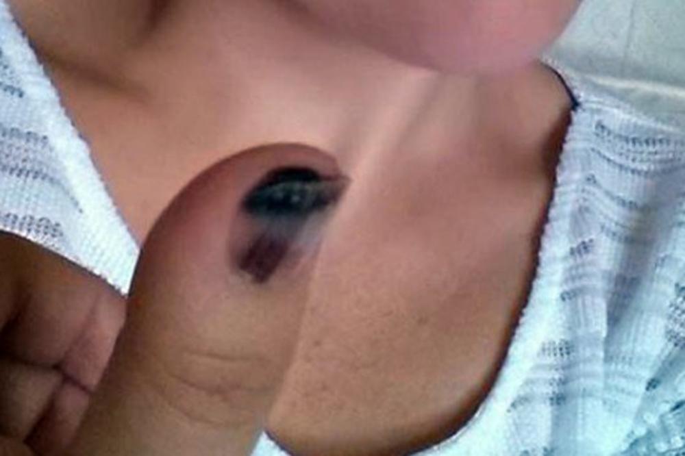 RAK NOKTA JE SVE ČEŠĆA POJAVA! Ovo su SIMPTOMI podmukle bolesti koju svi mešaju sa manjkom vitamina u TELU!