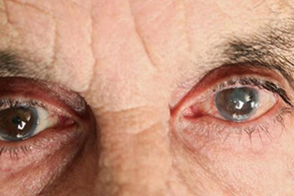 NE POSTOJI DOMAĆI RECEPT KOJI LEČI OČNE BOLESTI