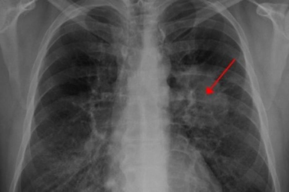 PRVI SIMPTOMI TEŠKE BOLESTI! Što se pre otkrije veće su šanse za IZLEČENJE