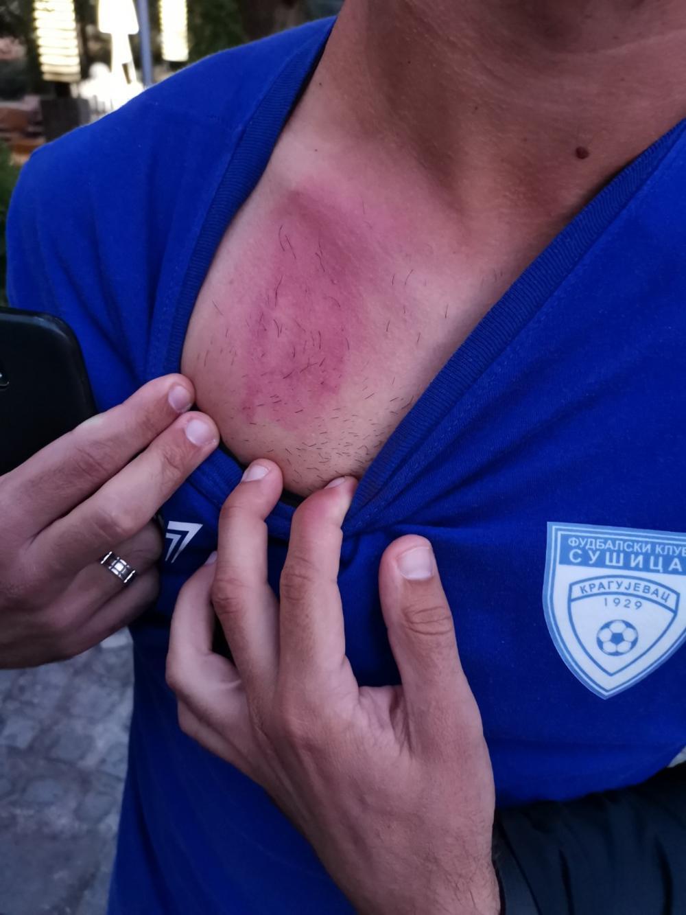 Fudbaler Sušice pokazuje povrede