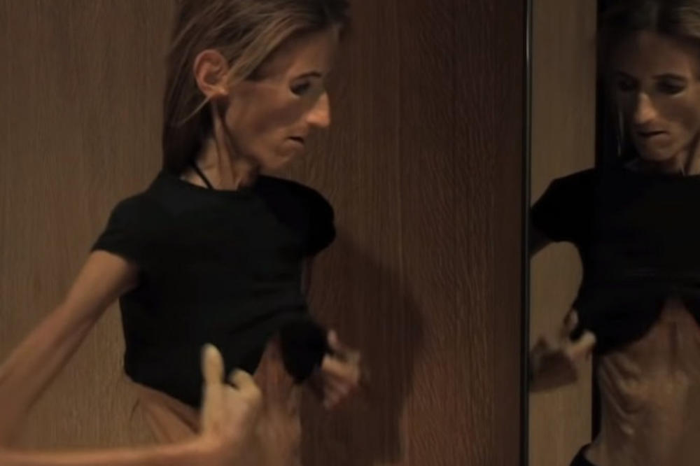 ONA JE NAJMRŠAVIJA ŽENA NA SVETU: Ima 25 kilograma i svima je odbojna! Otkrila kako je došla do tog stanja (VIDEO)