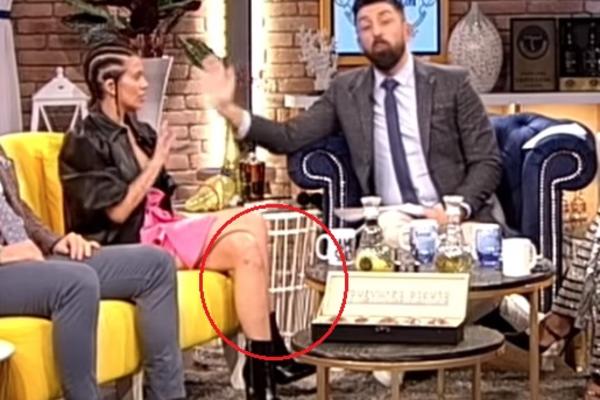 KIJA SVA U MODRICAMA DOŠLA U EMISIJU: 6 dana posle INCIDENTA sa Slobom, a rane su još uvek VIDLJIVE! (FOTO)