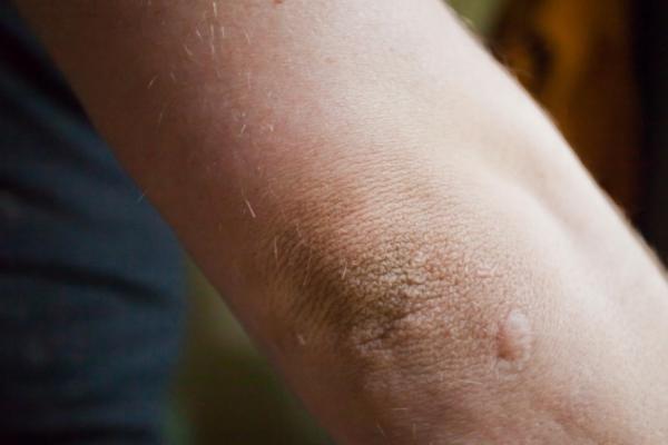 OVO JE NAJODVRATNIJI DEO TELA KOJI SVI SAKRIVAJU NA PROLEĆE: Svakome je gadan