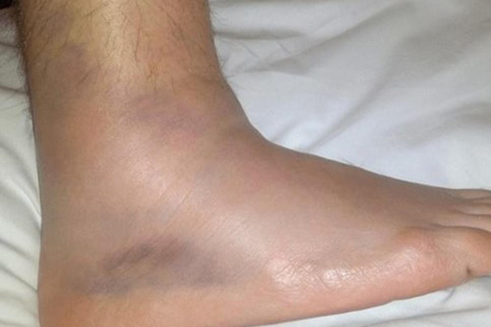 JAKO JE OPASNO, A NIKO TO NE UZIMA ZA OZBILJNO! Ukoliko vidite ovo na NOGAMA, odmah pozovite HITNU POMOĆ!