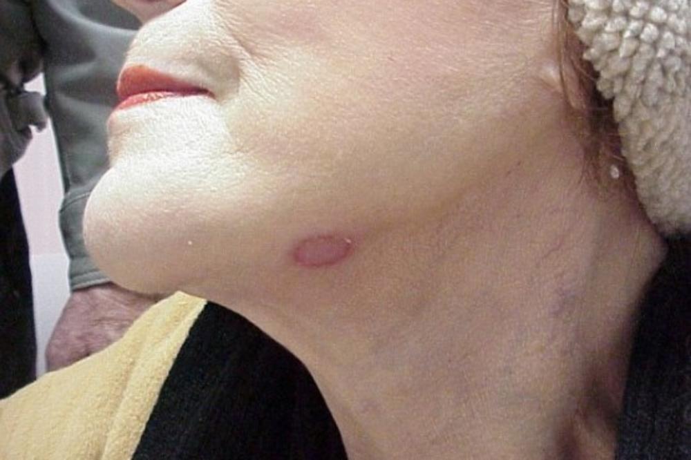 UKOLIKO PRIMETITE OVAKVE KRUGOVE, ODMAH MORATE DA POČNETE SA LEČENJEM! Ne gubite ni minut vremena, jako je OPASNO!