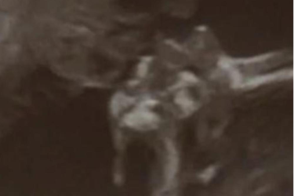 NA ULTRAZVUKU UGLEDALA JEZIVI PRIZOR: Pored BEBE je stajao POKOJNIK! (FOTO)