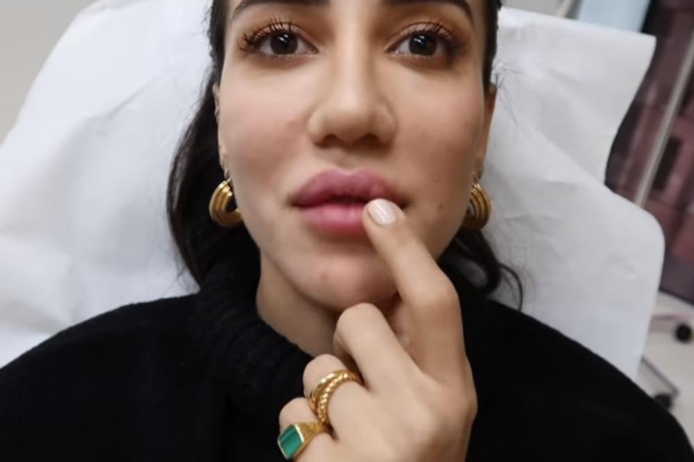 TAMARA KALINIĆ SNIMILA UŽIVO VAĐENJE FILERA IZ USANA: Poznata srpska jutjuberka SMANJILA USTA!