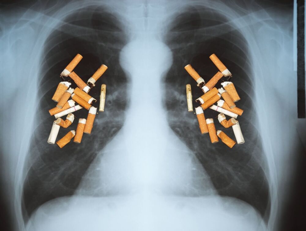 Rak pluća / ilustracija