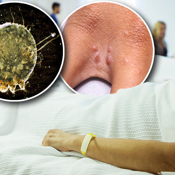 SRPSKI PROFESOR UPOZORAVA! Šuga je bolest od koje se leče svi ukućani, PAKAO ZA MOŠNICE - EVO KAKO SE ŠIRI ZARAZA