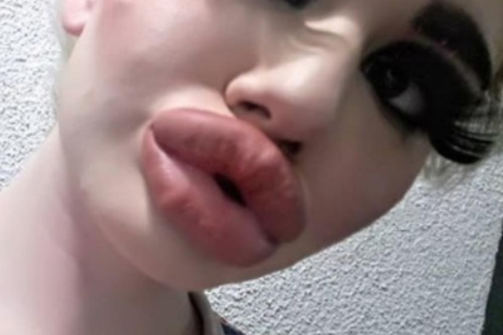 OVAKVU LUJKU JOŠ NISTE VIDELI: Ona želi da ima najveće usne na svetu, a nije baš prijatno za gledanje (FOTO)