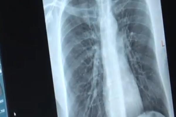 DEČAK JE HITNO PREVEZEN U BOLNICU! KAD SU DOKTORI URADILI RENDGEN, umalo se nisu ONESVESTILI!