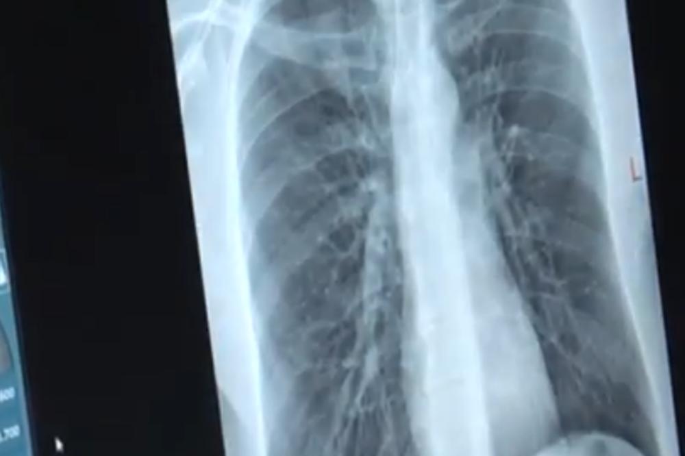 DEČAK JE HITNO PREVEZEN U BOLNICU! KAD SU DOKTORI URADILI RENDGEN, umalo se nisu ONESVESTILI!