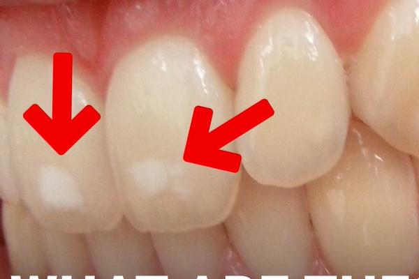 AKO IMATE BELE MRLJE NA ZUBIMA, obavezno pročitajte ovaj tekst!