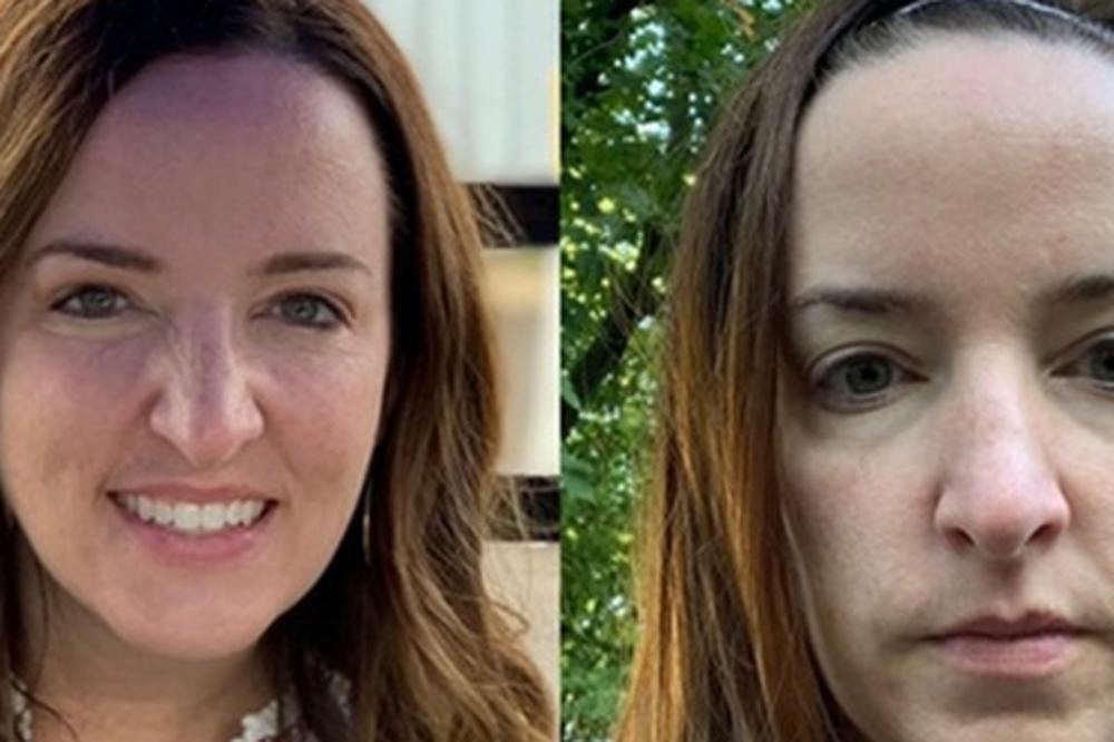 PREKO NOĆI SAM DOBILA BORE I OSTALA BEZ KOSE: Razlika u ove 2 slike je SAMO DVE NEDELJE, sve je počelo 1 POZIVOM