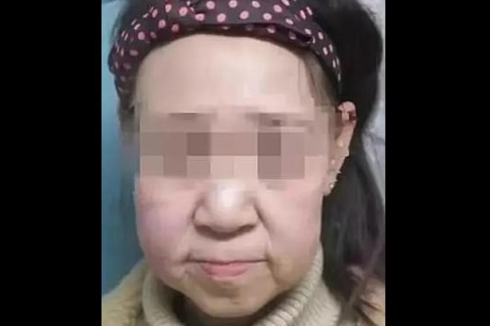 DEVOJČICA (15) JE ZBOG RETKE BOLESTI IZGLEDALA KAO STARICA: Svi su je izbegavali, onda je OPERACIJA sve promenila!