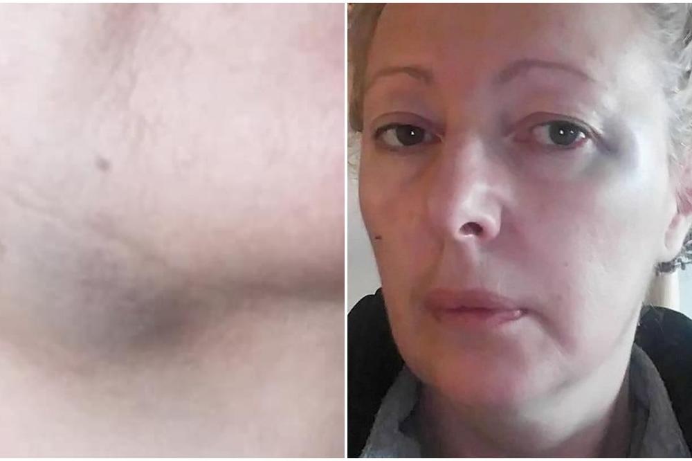 2 PUTA JE UDARIO PESNICOM U GLAVU, PA JOJ STRGAO SLUŠALICE! Migrant pretukao poznatu NOVINARKU (FOTO)