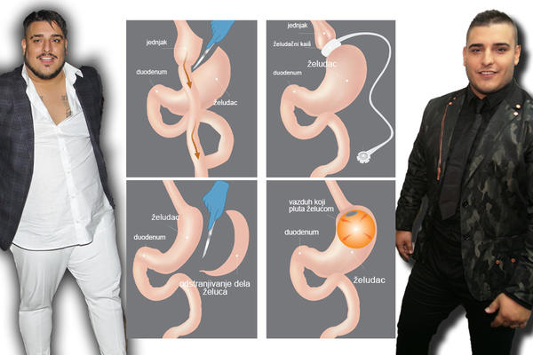 OVAKO SADA IZGLEDA ŽELUDAC DARKA LAZIĆA: Ovo su detalji OPERACIJE! (FOTO)