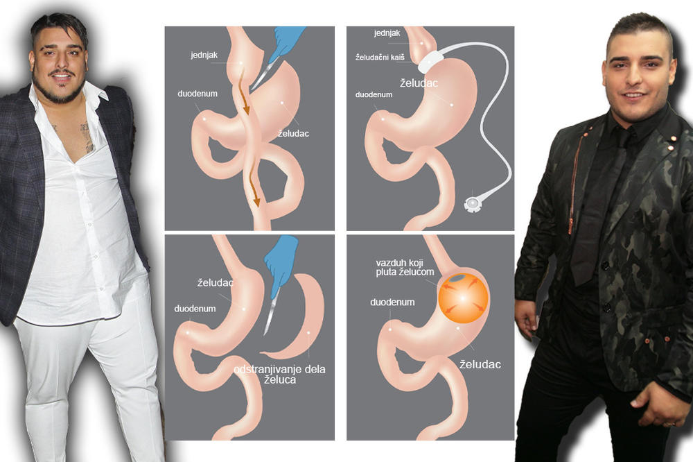 OVAKO SADA IZGLEDA ŽELUDAC DARKA LAZIĆA: Ovo su detalji OPERACIJE! (FOTO)