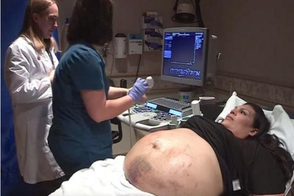 TRUDNIČKI STOMAK OVE ŽENE JE BIO PREKRIVEN MODRICAMA! Ultrazvuk je pokazao nešto STRAVIČNO! (VIDEO)