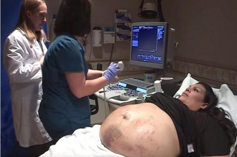 TRUDNIČKI STOMAK OVE ŽENE JE BIO PREKRIVEN MODRICAMA! Ultrazvuk je pokazao nešto STRAVIČNO! (VIDEO)