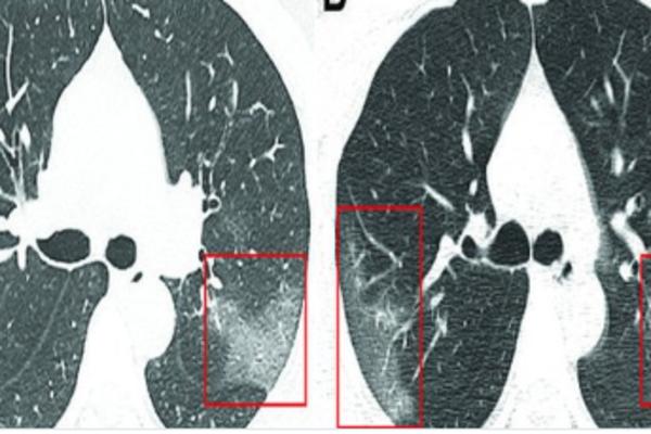ŠOKANTAN SNIMAK PLUĆA ZARAŽENIH OD KORONAVIRUSA: Lekari uočili bele senke poput MLEČNOG STAKLA (FOTO)