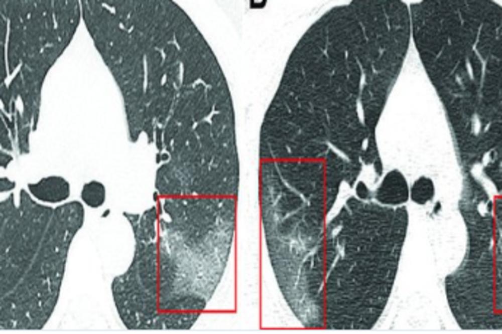 ŠOKANTAN SNIMAK PLUĆA ZARAŽENIH OD KORONAVIRUSA: Lekari uočili bele senke poput MLEČNOG STAKLA (FOTO)