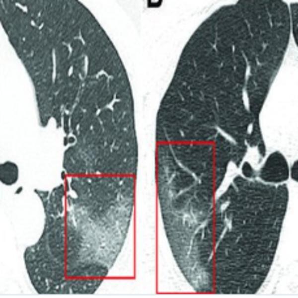 ŠOKANTAN SNIMAK PLUĆA ZARAŽENIH OD KORONAVIRUSA: Lekari uočili bele senke poput MLEČNOG STAKLA (FOTO)