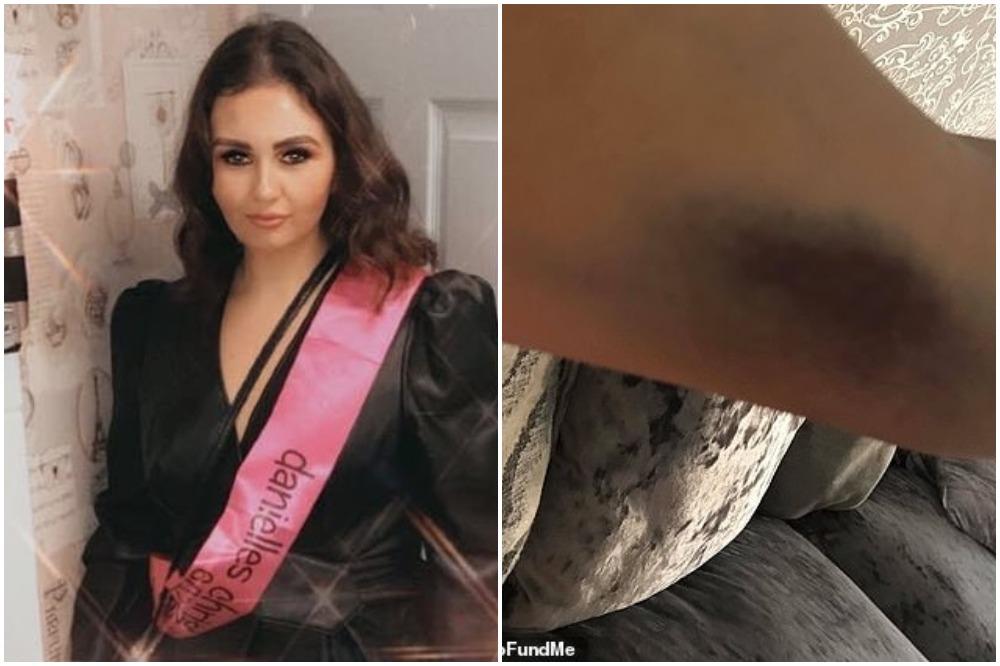 SARA (22) JE ODJEDNOM DOBILA ČUDNE MODRICE PO TELU: Nedelju dana kasnije bila je MRTVA!