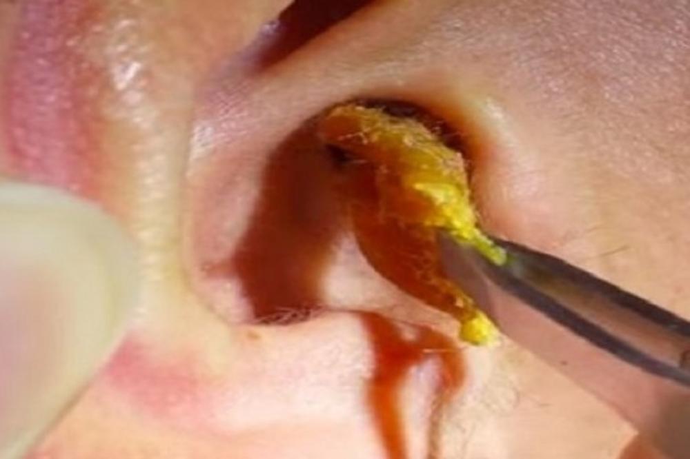 BOJA VOSKA IZ UŠIJU DOSTA GOVORI O VAŠEM ZDRAVLJU: Ako je ove boje, ODMAH idite kod doktora!