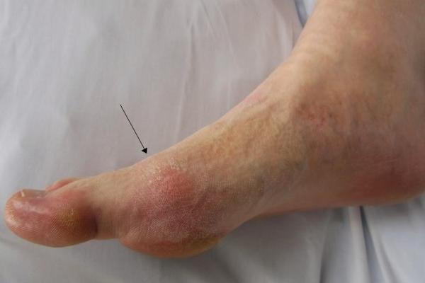 11 ZNAKOVA DA VAM ŠEĆER RAZARA ORGANIZAM: Ne ignorišite ih, važno je da prepoznate simptome!