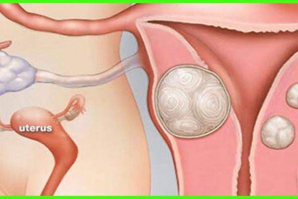 ŽENE, OBRATITE PAŽNJU! OVO JE OPAKA BOLEST KOJA NAPADA JAJNIKE: Možda niste ni svesne OVIH 6 SIMPTOMA!