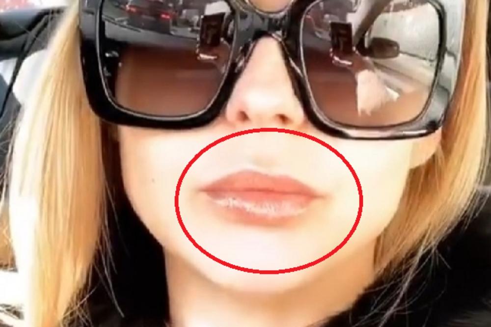 ŠTA SE DEŠAVA SA PEVAČICOM GRANDA? Uključila lajv, svi primetili POTPUNO KRIVA USTA, facijalis ili greška HIRURGA