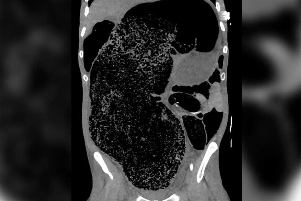 SKORO UMRO ZBOG OGROMNOG IZMETA koji mu se gomilao u crevima 3 DANA!