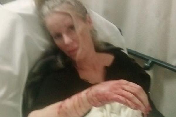 GLUMICU ISKIDALI PITBULOVI! Ugradili joj ŠINE u ruku, prelomi KOSTIJU, pokidani LIGAMENTI (JEZIVE SLIKE)