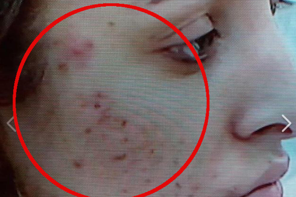 LUNA U ZADRUZI ZARADILA JEZIVE AKNE NE LICU: Stanje alarmantno!