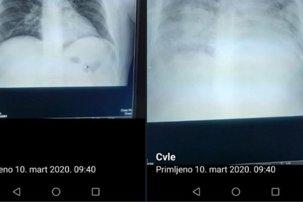 VIRUS JE ZA 24 SATA RAZORIO PLUĆA MOMKA IZ KRAGUJEVCA: Umro je, hirurg objavio snimke pre i posle (FOTO)