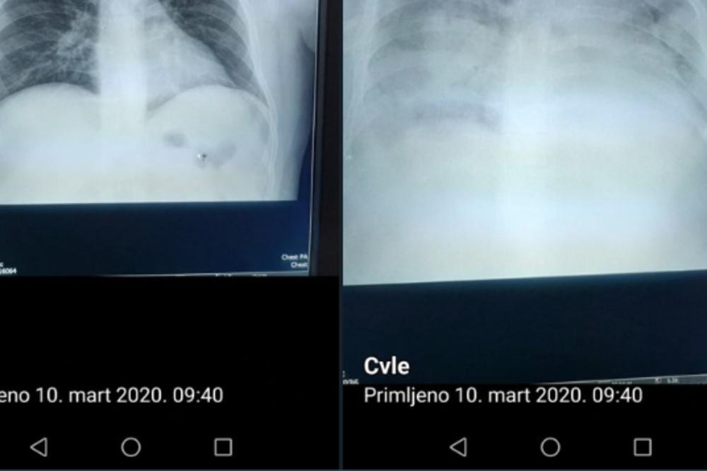 VIRUS JE ZA 24 SATA RAZORIO PLUĆA MOMKA IZ KRAGUJEVCA: Umro je, hirurg objavio snimke pre i posle (FOTO)