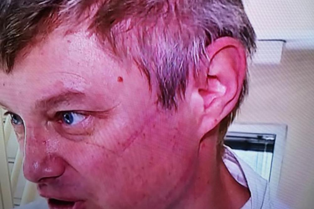 POGLEDAJTE SAMO RANE NA LICU DR STEVANOVIĆA: Ako posle ovoga ne ostanete kod kuće, onda ste baš SEBIČNI!