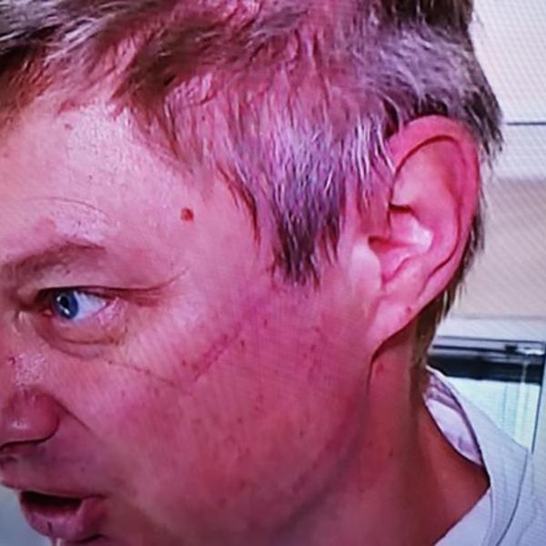 POGLEDAJTE SAMO RANE NA LICU DR STEVANOVIĆA: Ako posle ovoga ne ostanete kod kuće, onda ste baš SEBIČNI!