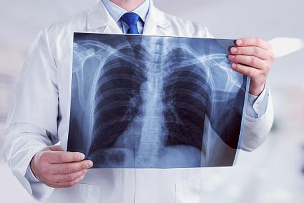 DEVOJKA NIJE IMALA NIJEDAN SIMPTOM, ALI JE TRAŽILA DA JOJ SNIME PLUĆA: Lekari širom sveta govore o ovom slučaju!