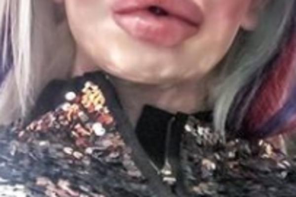 FANOVI IZVREĐALI STARLETU JER JE PREPUMPALA USTA! Izgledaju ko kobasice, a od veličine više ne može ni da jede