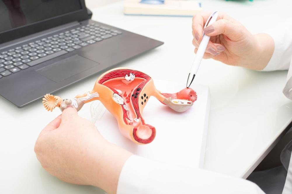 AKO PRIMETITE BILO KOJI OD OVIH SIMPTOMA, POSETA LEKARU SE NE ODLAŽE: Ovo su PRVI ZNAKOVI raka jajnika i materice