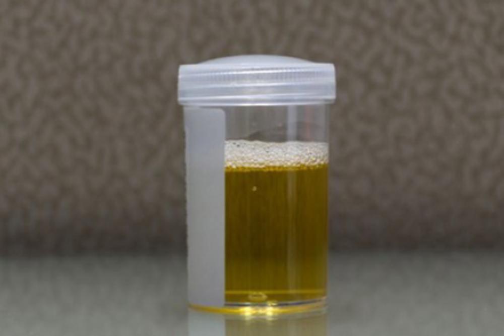 VODITE RAČUNA: Ako vam je urin ove boje i mirisa odmah se obratite lekaru!