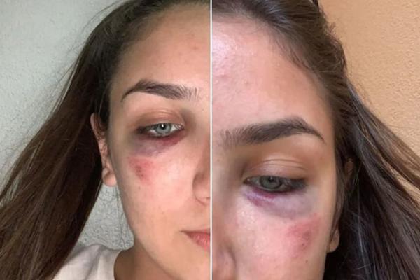 HOROR! JEZIVO PRETUČENE SPORTISTKINJE IZ BOSNE: U ponoć im je upao u kuću i iživljavao se nad njima! (UZNEMIRUJUĆE)