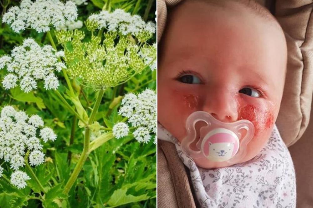 BEBA ZADOBILA UŽASNE OPEKOTINE OD OVE BILJKE: Pazite se, raste svuda! (FOTO)