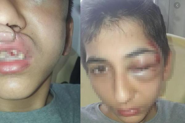 SRPSKI DEČAK (14) KOG SU PRETUKLI POLICAJCI U PARIZU JE OPERISAN: Sledeća 24 sata su za njega KLJUČNA