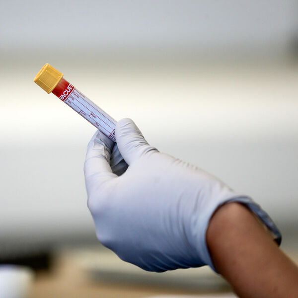 AKO IMATE OVU KRVNU GRUPU, LOŠE VAM SE PIŠE: Nosioci teže obole od KORONE i češće završe na RESPIRATORU!